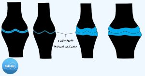 افزایش قد با غضروف‌سازی و ضخیم‌کردن غضروف