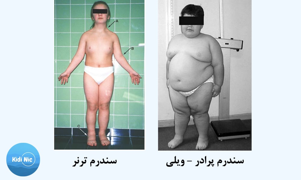 کمبود هورمون رشد