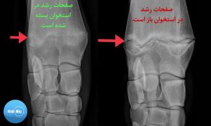 افزایش قد بعد از بلوغ در دختران و پسران