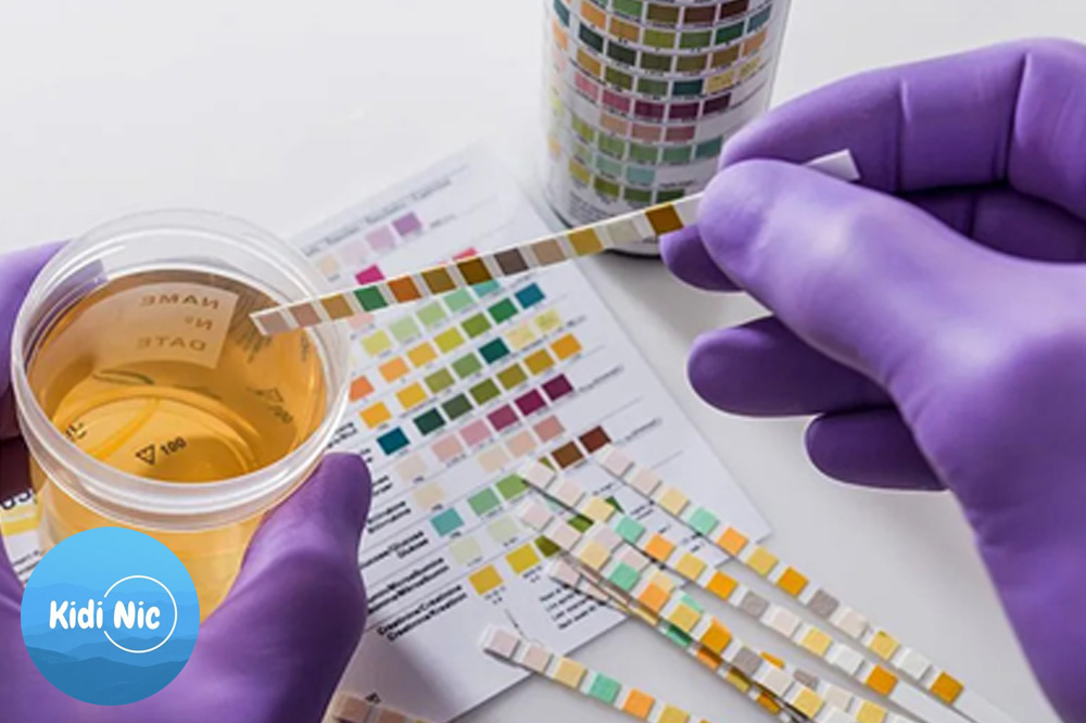 آزمایش عمومی آنالیز ادرار (Urinalysis یا UA)