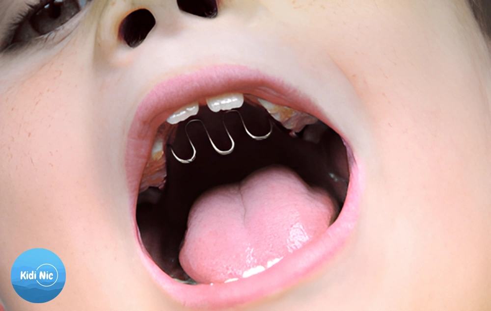 استفاده از پالاتال کریب